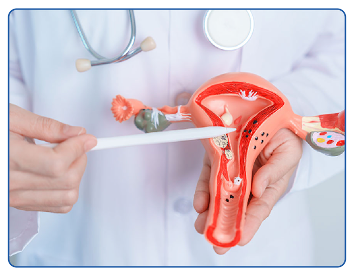 Hysterectomy