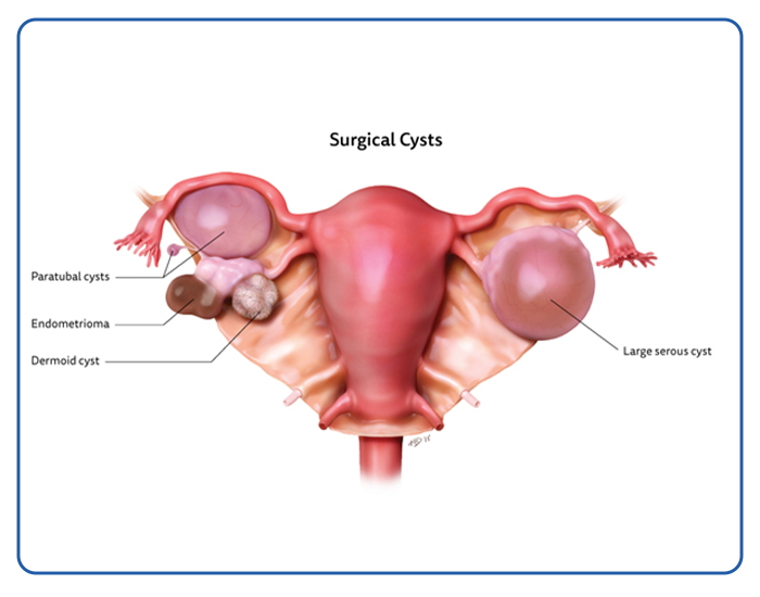 Cystectomy